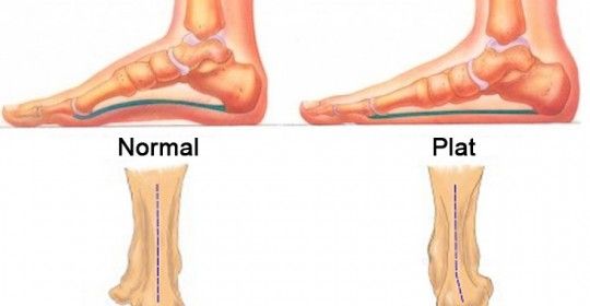 Tratamentul artrozei piciorului nutriție - Unguente și geluri din mușchi și articulații