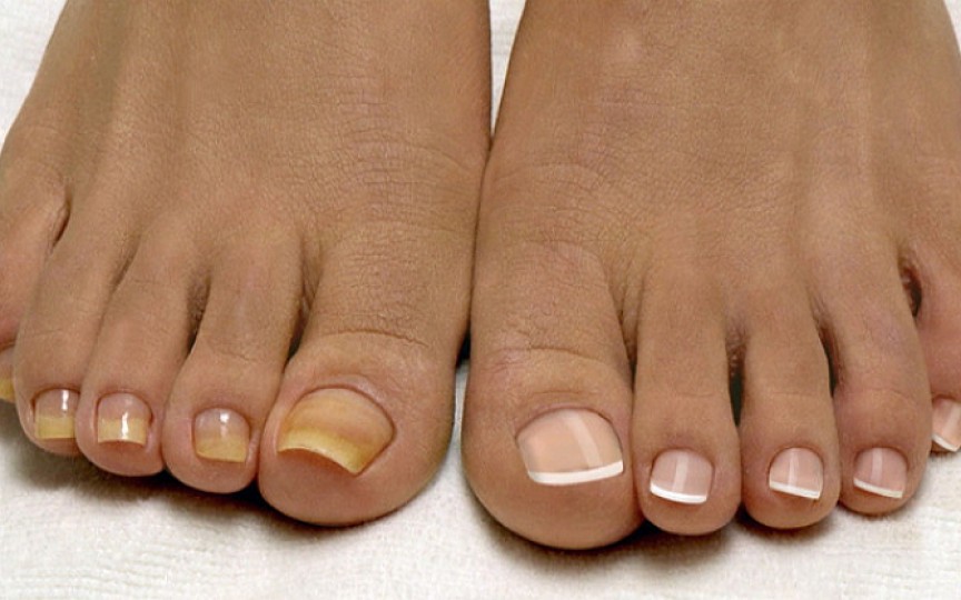 primele semne ale apariției unei ciuperci pe unghiile picioarelor