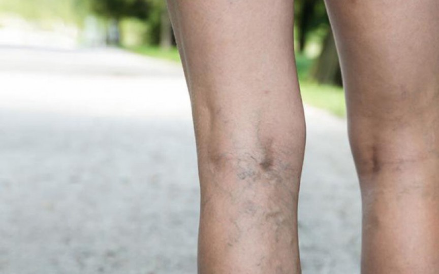 De ce are pigmentarea pielii pe picioare cu varice și cum să scapi de ea