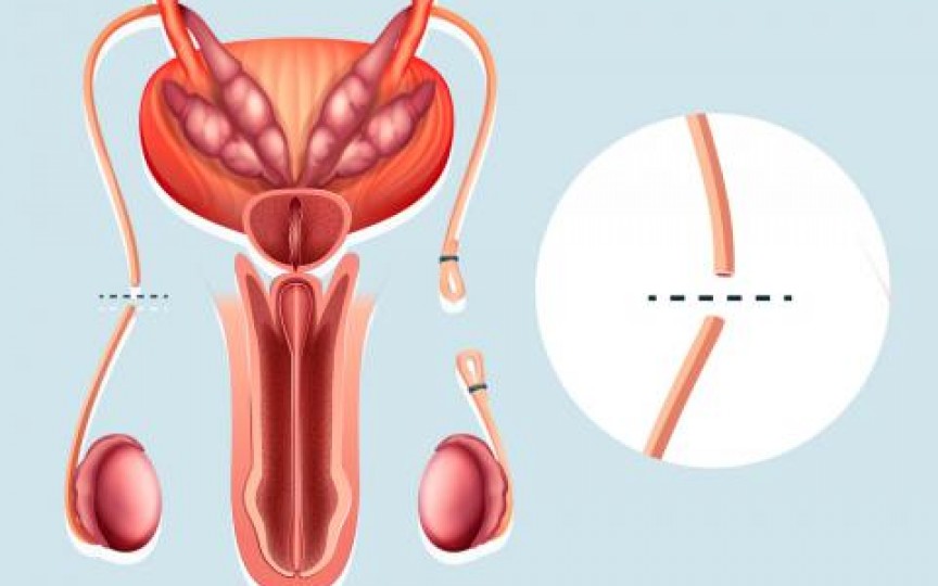 sterilizare și erecție