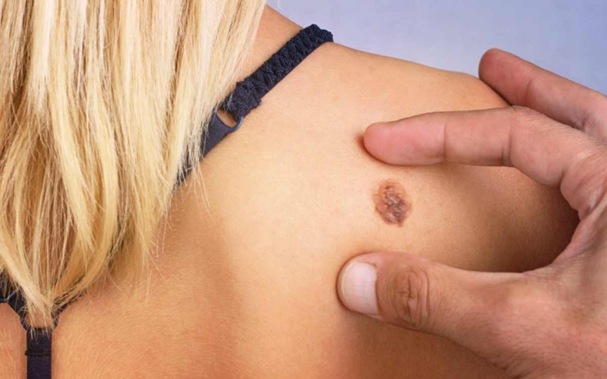 Cum să îți verifici pielea pentru observa semnele ce anunță cancerul de piele