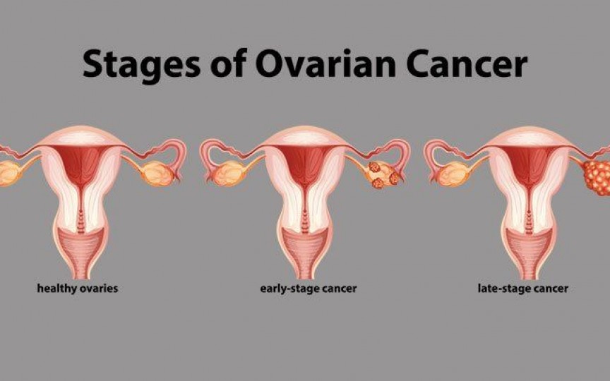 simptome cancer ovare)