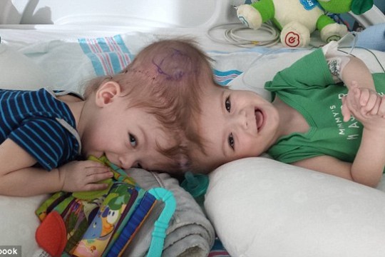 După 27 de ore de operație, doi gemeni alipiți în zona capului au fost separați. Imagini emoționante!