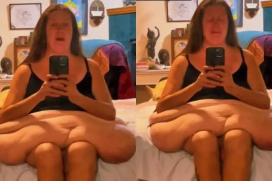 O femeie care a cântărit aproape 300 de kg cândva a publicat un clip video cu excesul de piele rămas: „Îmi atârnă până la genunchi”