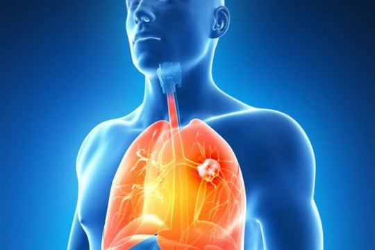 Este în creștere umărul persoanelor care suferă de cancer pulmonar