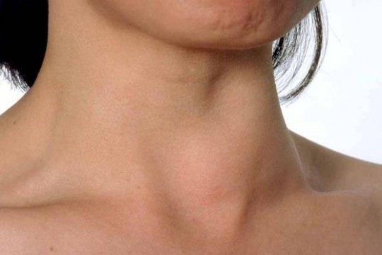 Cel mai evident simptom al lipsei de iod din organism - cauza bolilor de tiroidă