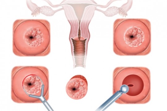 Rana pe col uterin nu dă dureri, dar poate duce la cancer