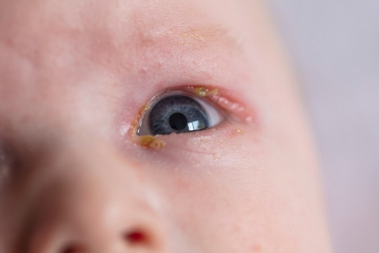 Canal lacrimal înfundat la bebeluși. Ce este de făcut