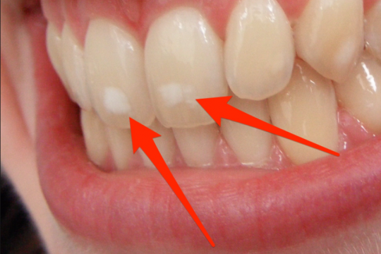 De ce apar pete albe pe dinți?