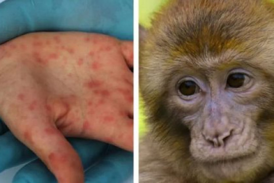 ANSP a pornit o anchetă epidemiologică în baza primului caz de variolă a maimuței înregistrat în Moldova. Care este starea pacientului?