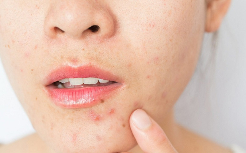 Avertisment medical: Rutinele de skincare promovate pe TikTok pot afecta grav pielea adolescenților