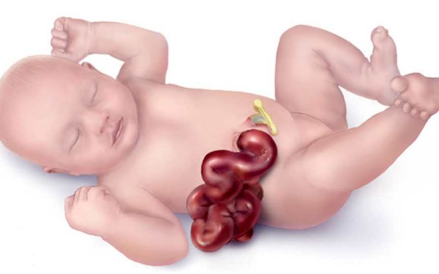 Gastroschizis la nou-născuți - una dintre cele mai frecvente malformații congenitale