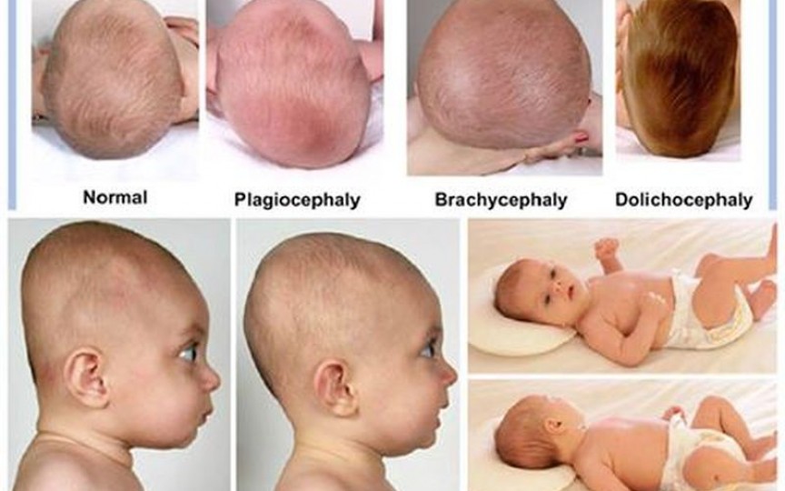 Sindromul plagiocefaliei (capul turtit la bebeluși)