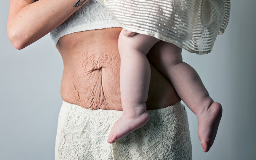 Medic dermatolog despre pielea lăsată după sarcină - soluții care funcționează