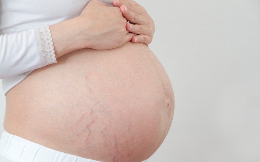 Vergeturile în sarcină: soluții pentru prevenirea și combaterea lor