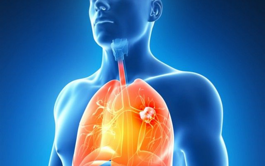 Este în creștere umărul persoanelor care suferă de cancer pulmonar