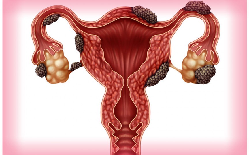 Endometrioza profundă - cauză de infertilitate