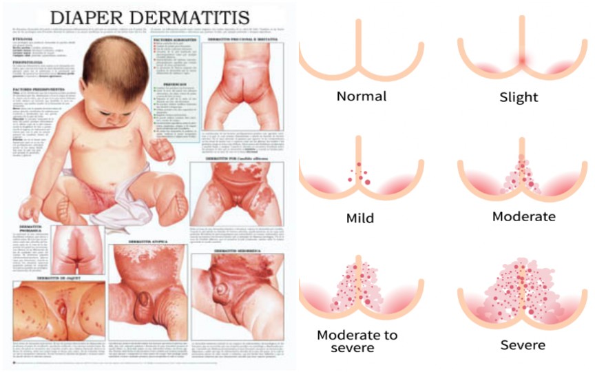 Dermatita de scutec, pe înțelesul părinților – sfaturi practice de la medic pediatru