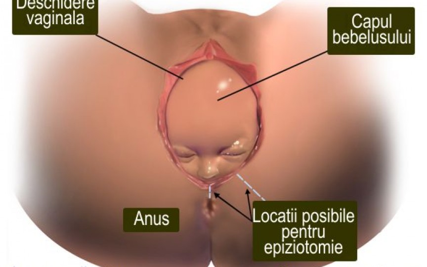 Expulzia fătului în timpul nașterii – când avem nevoie de epiziotomie