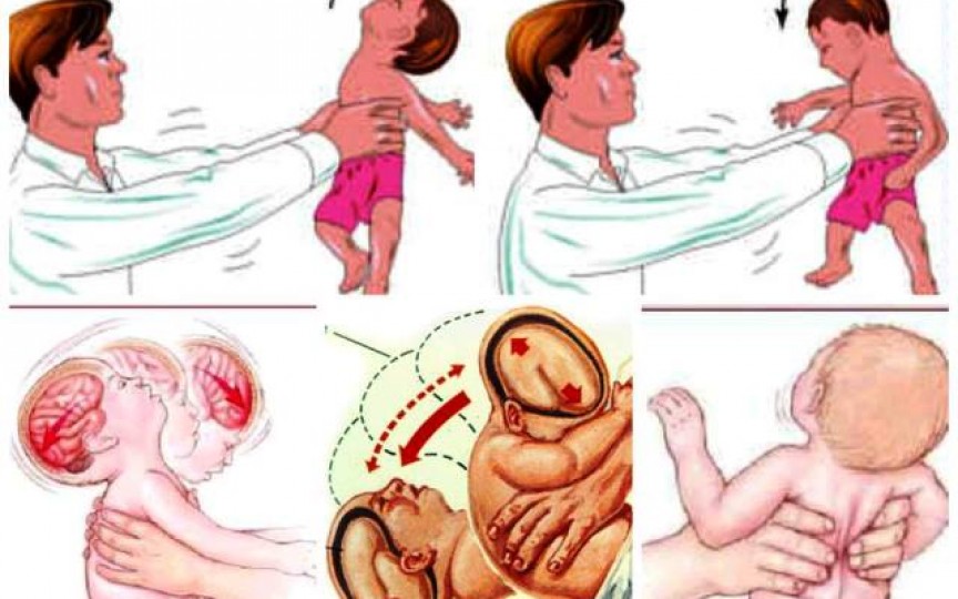 Medic neurolog-pediatru: Zgâlțâitul bebelușului are efecte asemănătoare impactului pe care îl suferă un adult în timpul unui accident de mașină