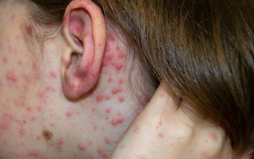 Alertă de rujeolă în Capitală: 5 copii și 3 adulți infectați. Autoritățile cer vaccinare urgentă