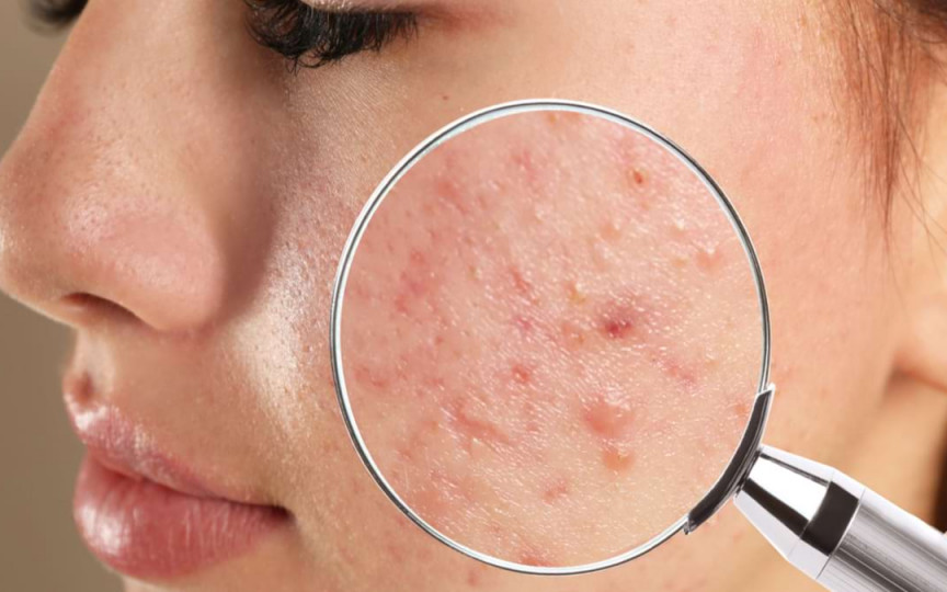 Cum să scapi de petele de acnee. Top 7 remedii naturiste