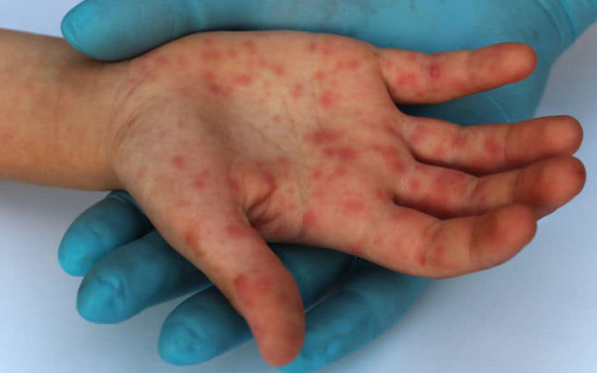 A fost înregistrat primul caz de variola maimuței în Republica Moldova