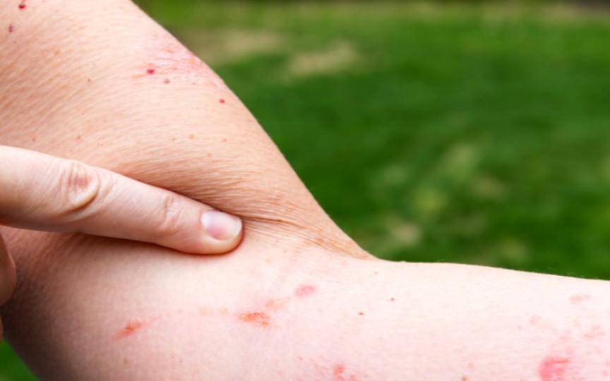 5 remedii pentru iritațiile produse de iedera otrăvitoare