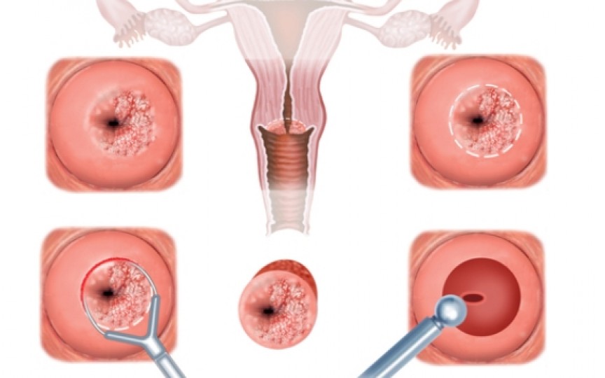 Rana pe col uterin nu dă dureri, dar poate duce la cancer