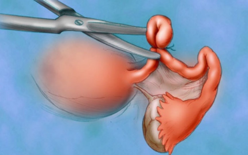 (VIDEO) Legarea trompelor uterine: cum se realizează și ce avantaje și dezavantaje are