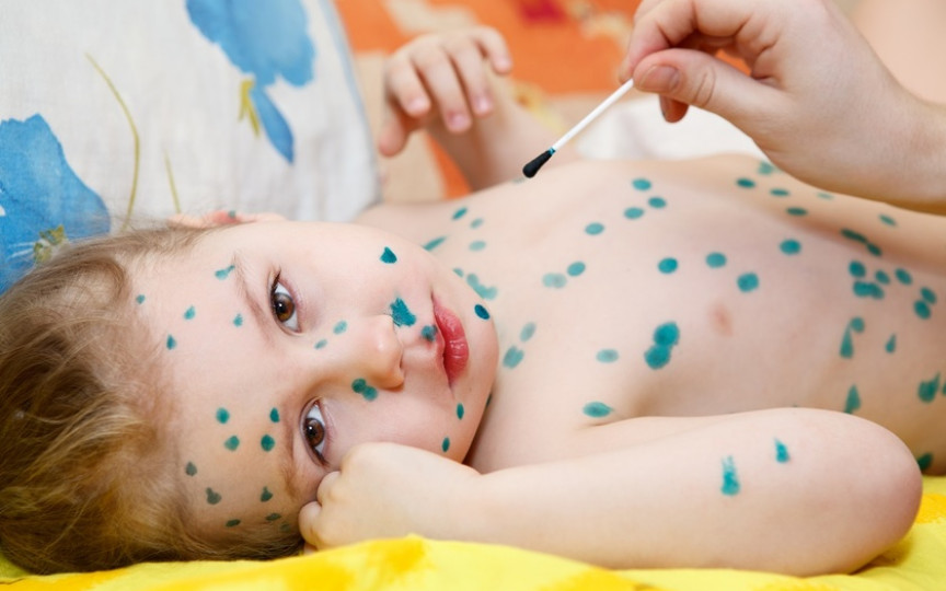Ce să NU facem în cazul în care copilul are varicelă – Nu petreceri cu varicelă, ci izolare strictă