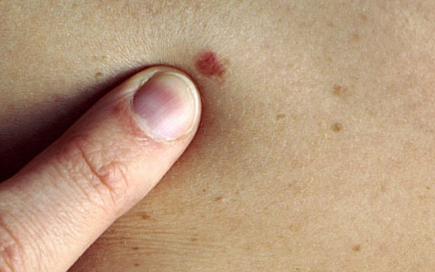 Semnele cancerului de piele, mai ales cele de pe unghiile de la mâini și de la picioare nu ar trebui, sub nicio formă, ignorate