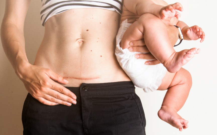 Studiu: Ce efecte are pe termen lung cezariana asupra mamei și copilului