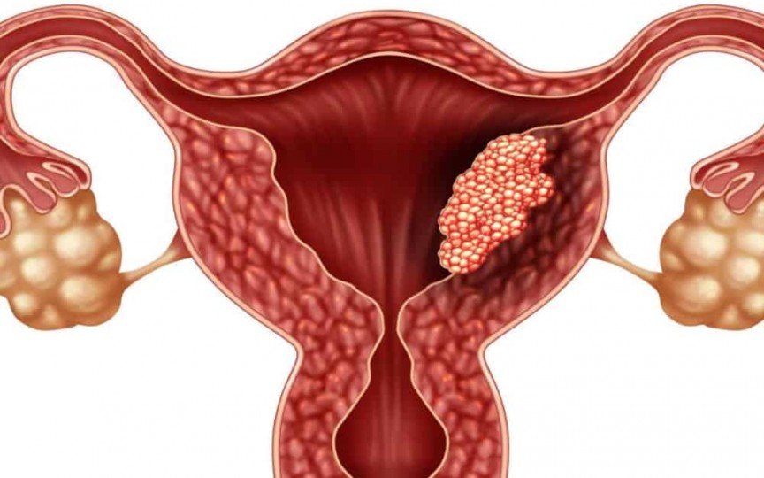 10 mituri demontate despre cancerul de col uterin – ucigașul a peste 300.000 de femei din întreaga lume