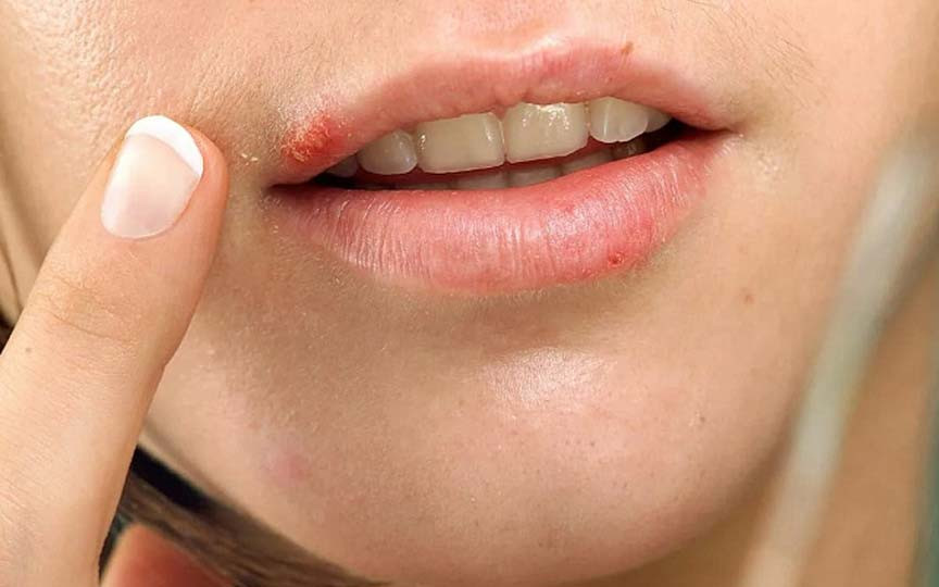 Remedii naturale eficiente pentru herpes: Cum să ameliorezi simptomele și să accelerezi vindecarea