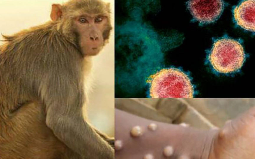 Primul caz de variola maimuței diagnosticat în România