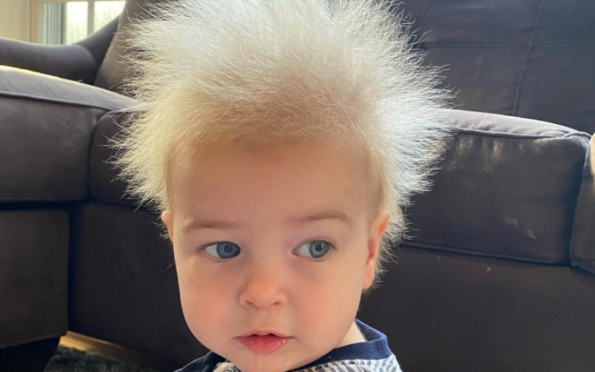 Băiețelul cu „sindromul părului de nepieptănat”.  Ce presupune această afecțiune (Foto)