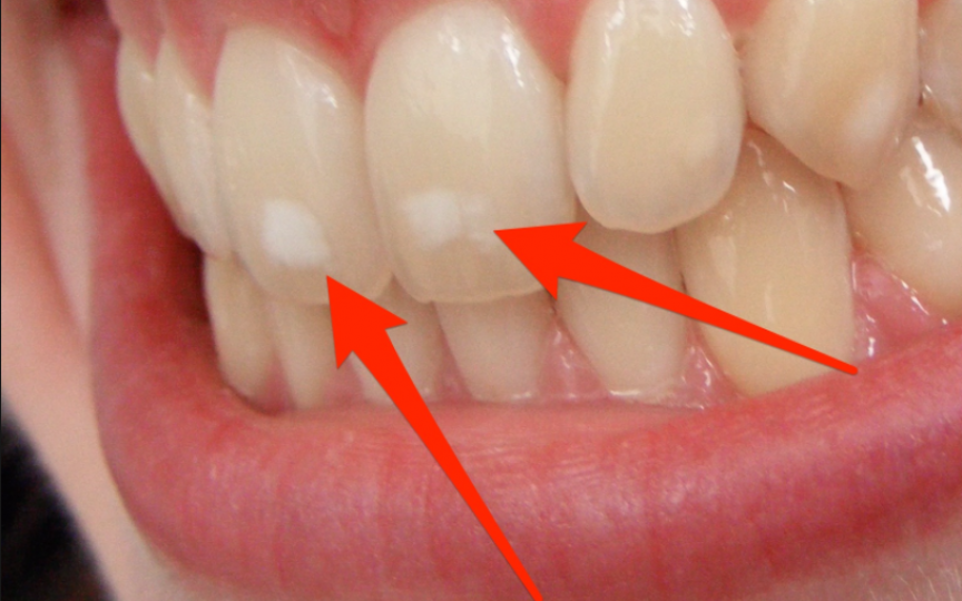 De ce apar pete albe pe dinți?