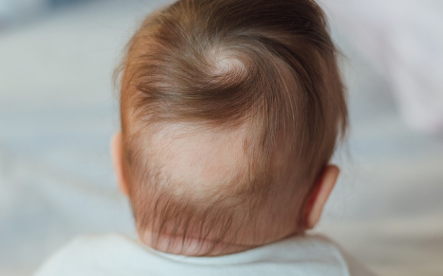 Cauzele căderii părului (alopecia), la bebeluși și copii