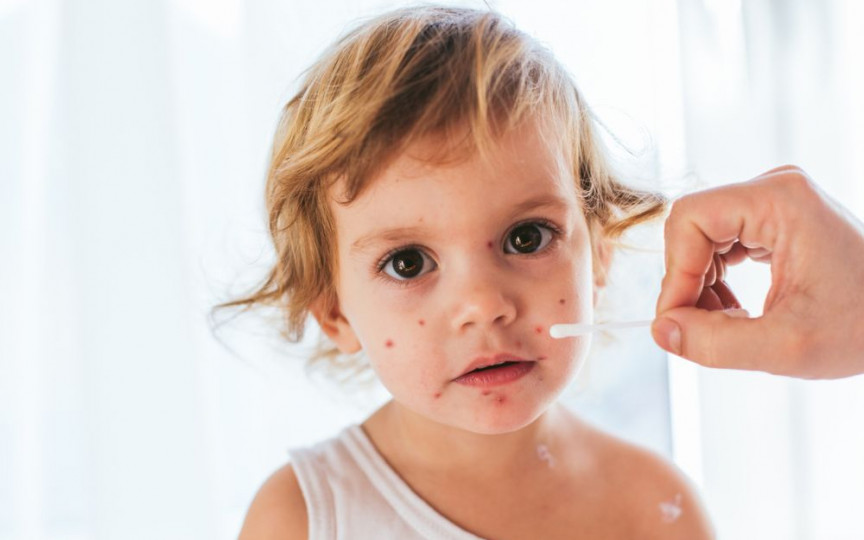 Mihai Craiu: „Petrecerile” cu varicelă reprezintă o formă de abuz împotriva copilului
