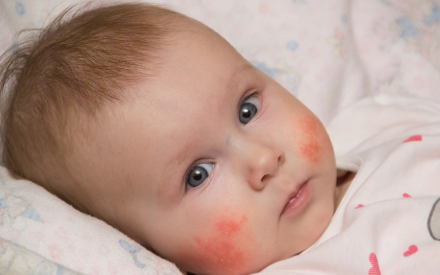Cauzele apariției dermatitei atopice și cum se tratează