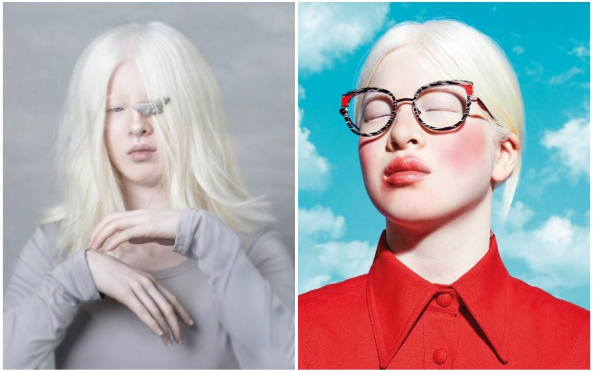 Istoria fetiței care a fost abandonată pentru că s-a născut cu albinism. Acum este un model de succes