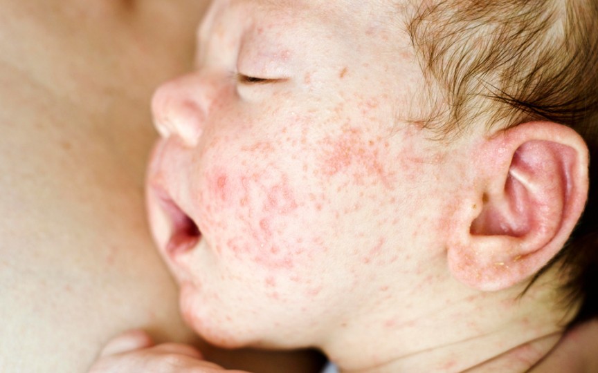 Complicațiile dermatitei atopice la copii și greșelile comise de părinți