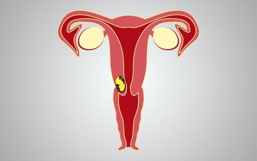 Cancer vaginal: factori de risc și simptome