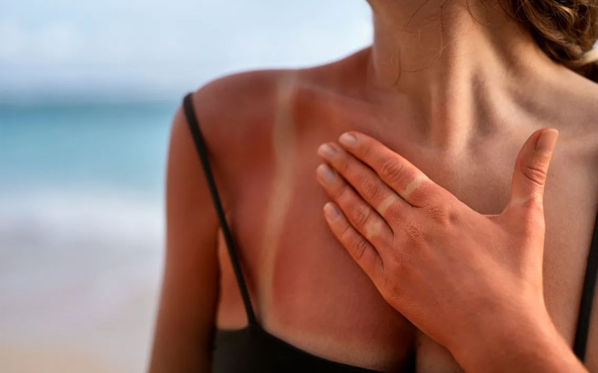 Aloe vera și uleiul de cocos te pot ajuta după arsuri solare – dar doar dacă le folosești la momentul potrivit