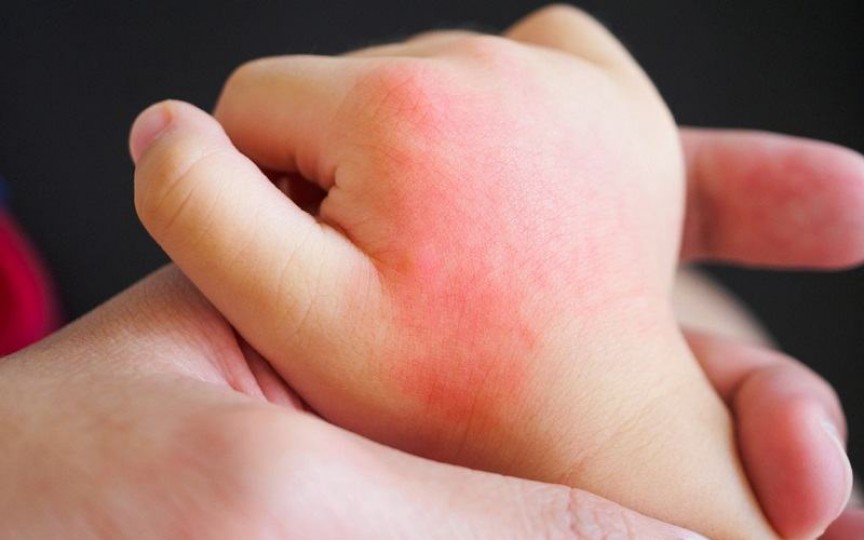 Medic dermatolog despre cum recunoaștem alergia solară la copii