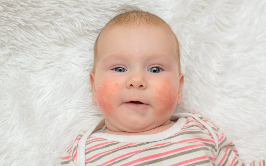 Alergia la laptele de vacă – cel mai frecvent tip de alergie la bebeluși