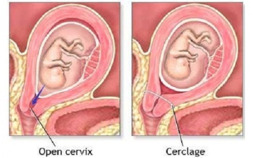 Cerclajul colului uterin - riscurile și beneficiile acestei proceduri