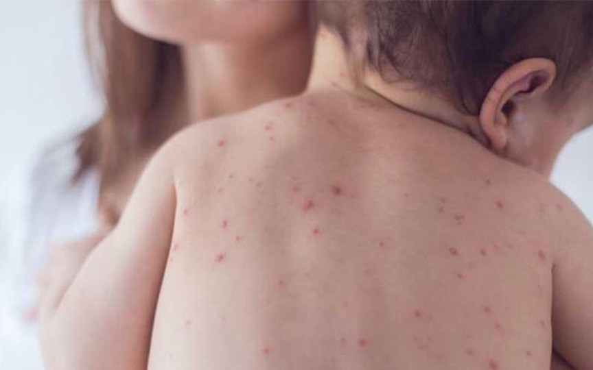 Ce este rozeola la copii și cum o recunoști: simptome, cauze și evoluție
