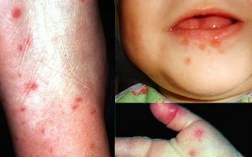 Câțiva moldoveni au contractat în Turcia boala gură-mână-picior. Mai expuși infecției sunt copiii